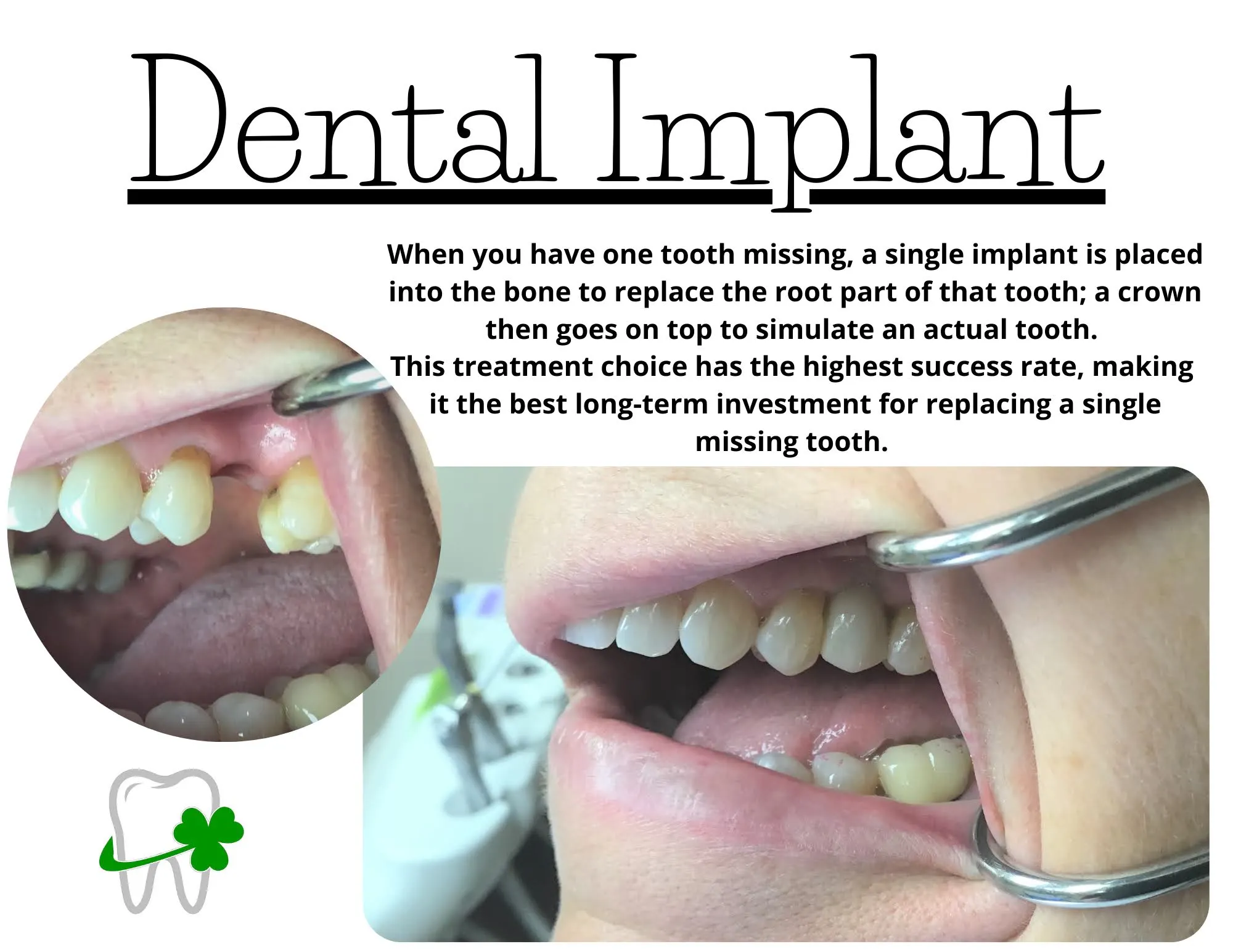 dental implants gone wrong