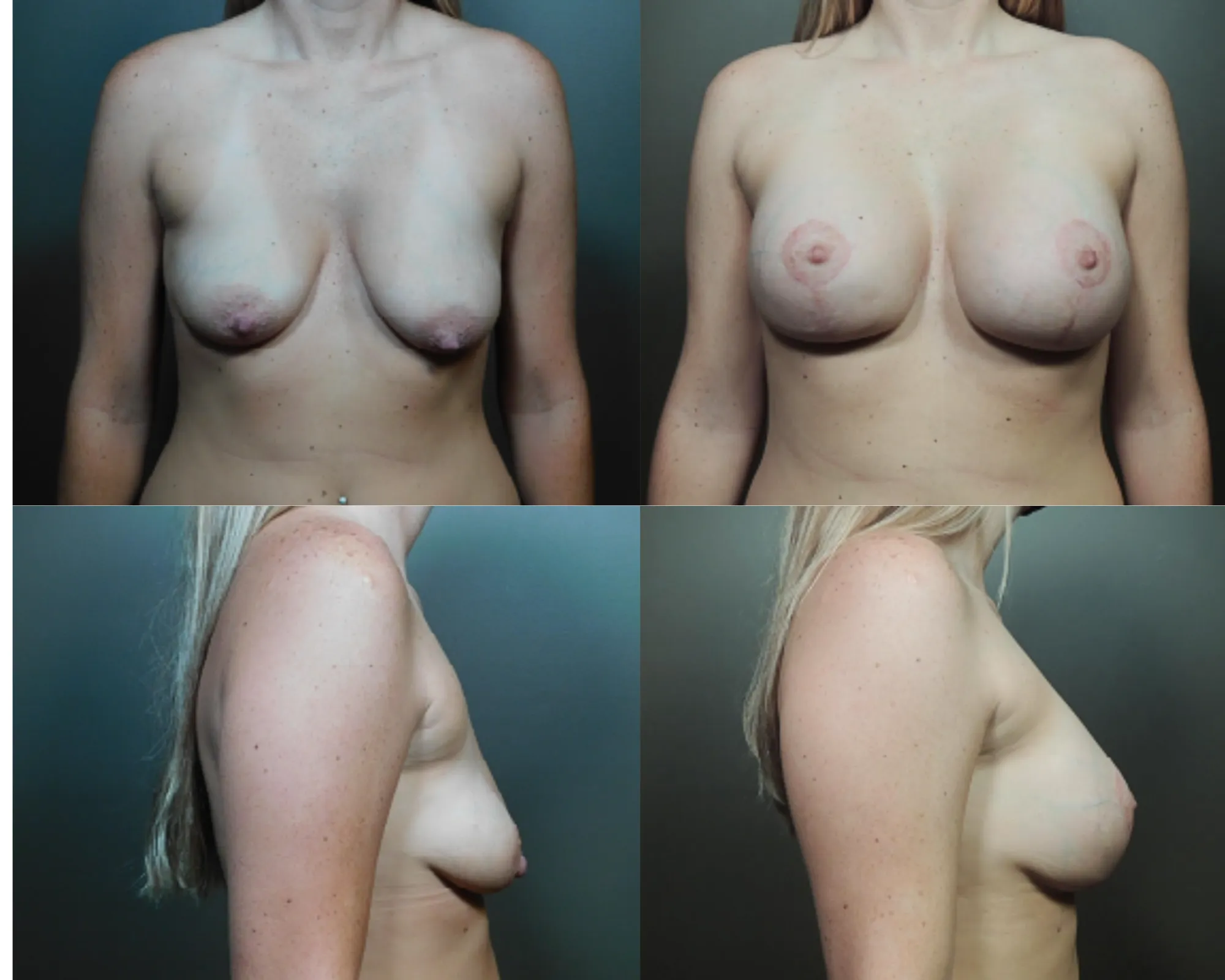 Augmentation And Lift Before and After_12