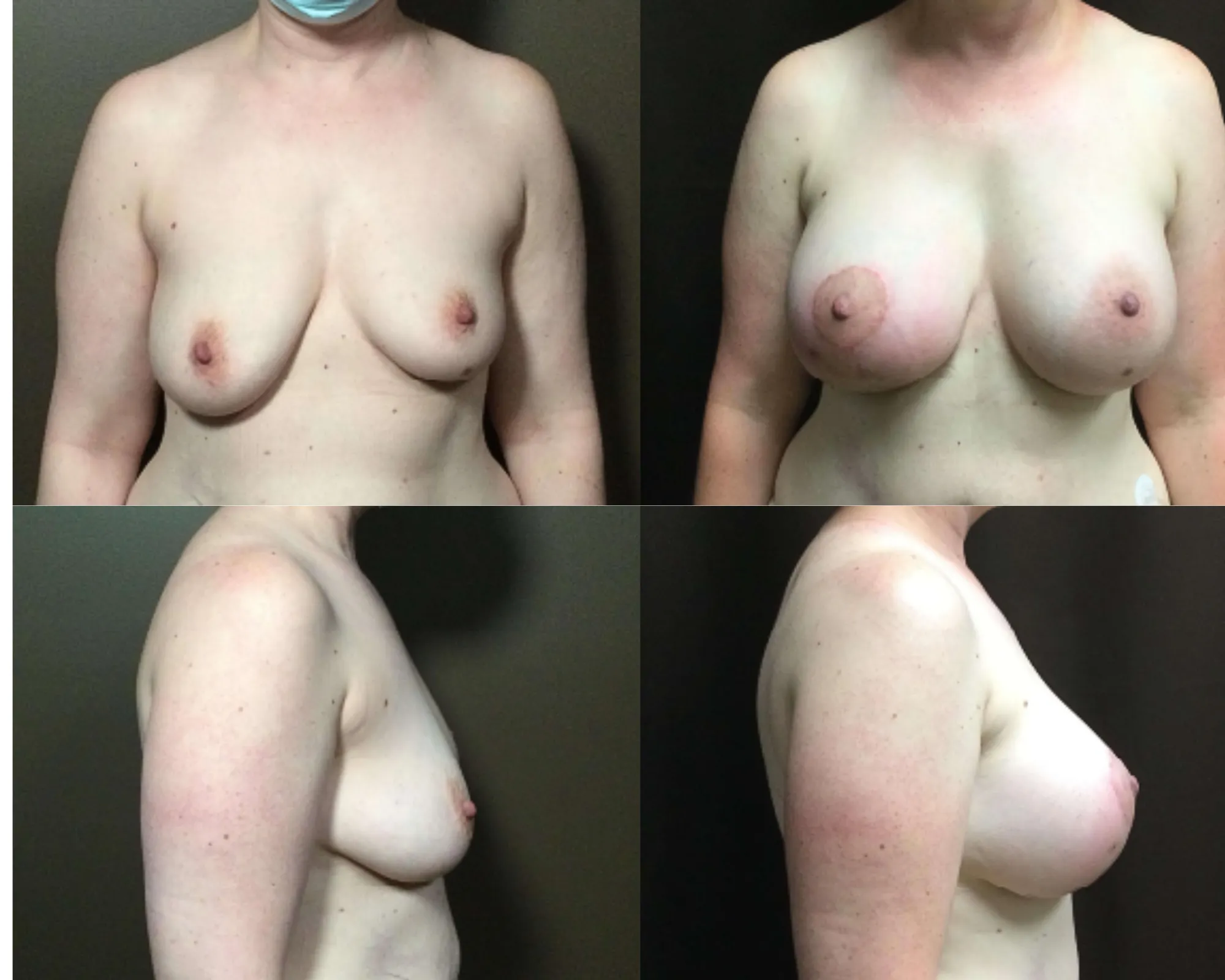 Augmentation And Lift Before and After_15