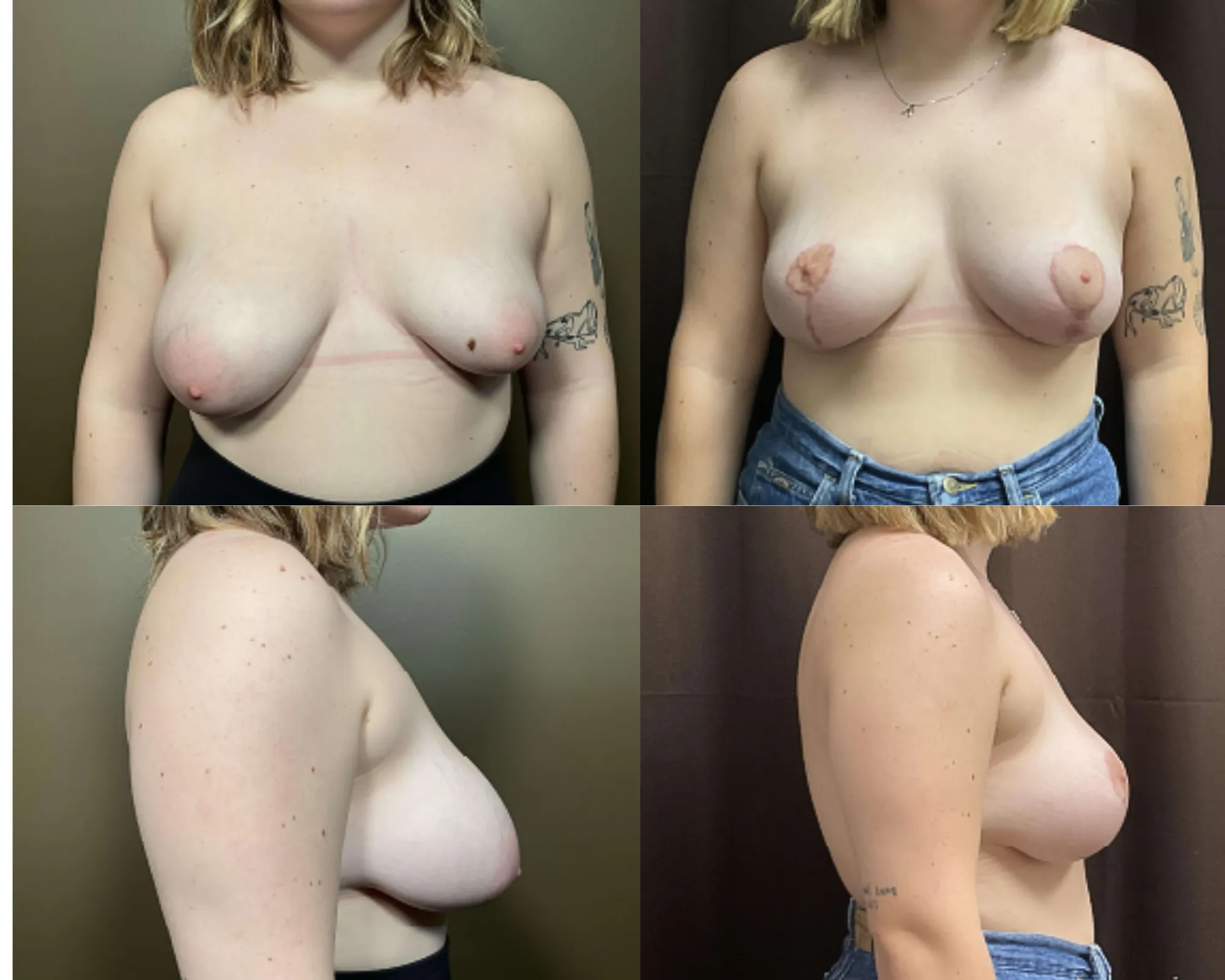 Augmentation And Lift Before and After_17