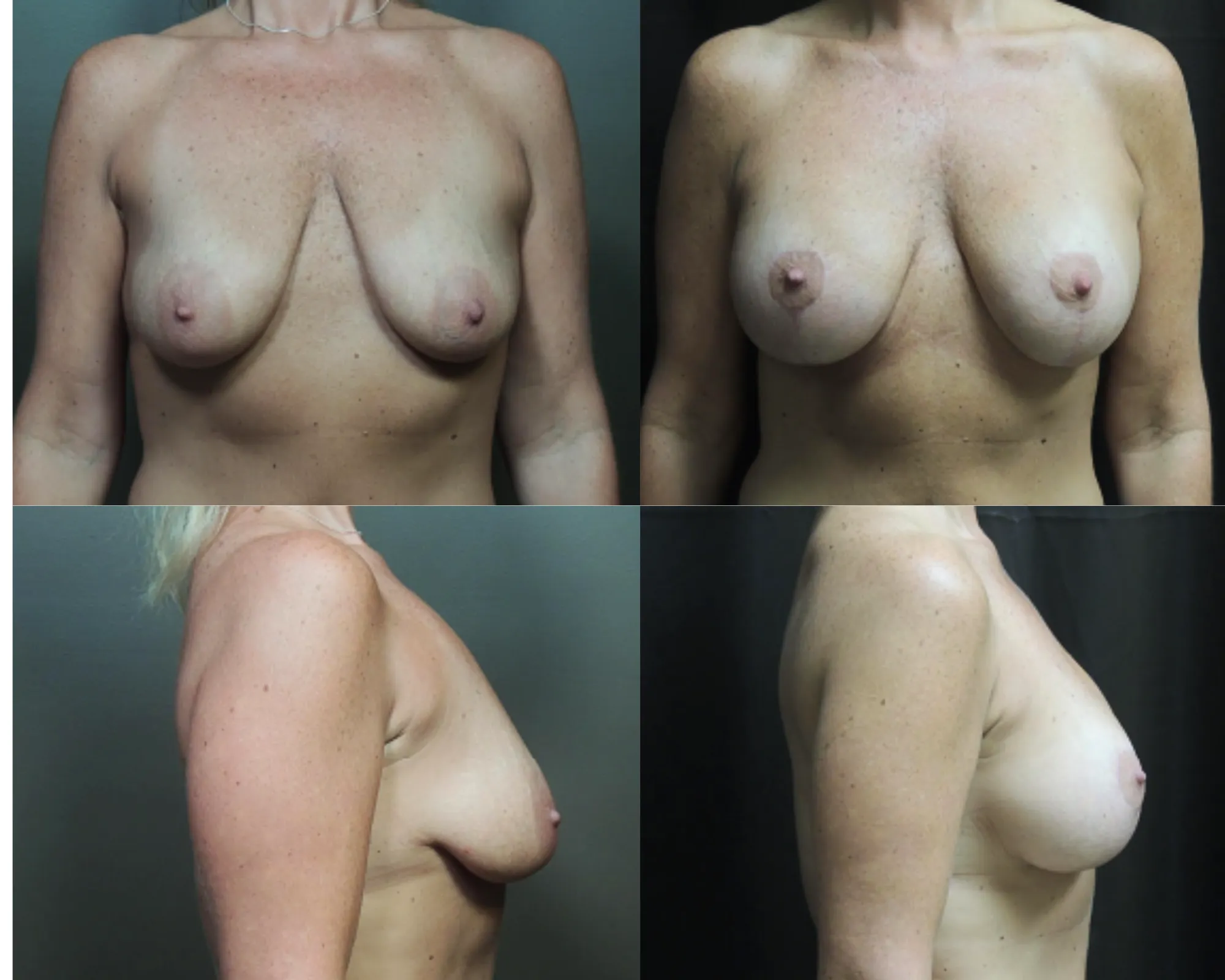 Augmentation And Lift Before and After_3