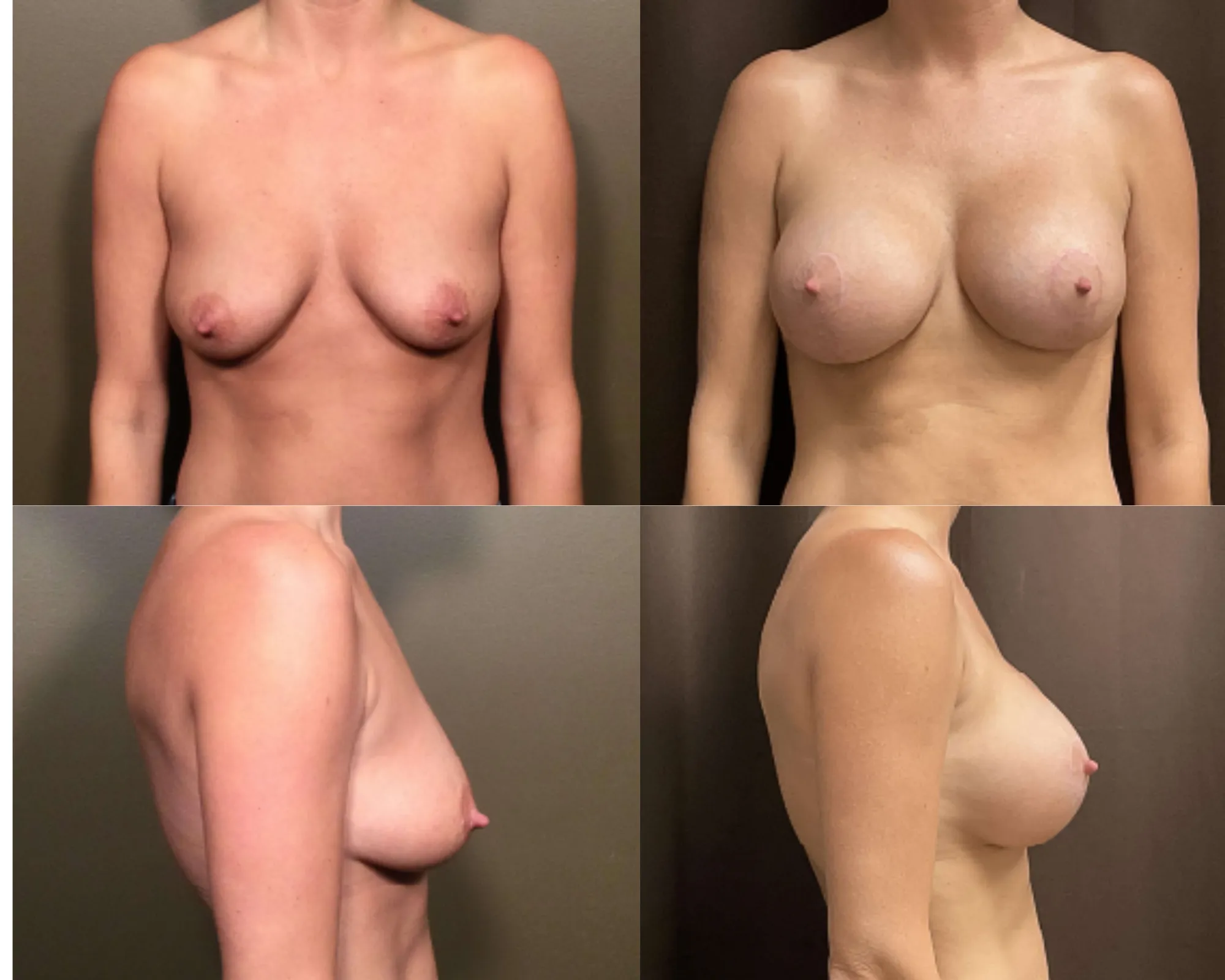 Augmentation And Lift Before and After_6