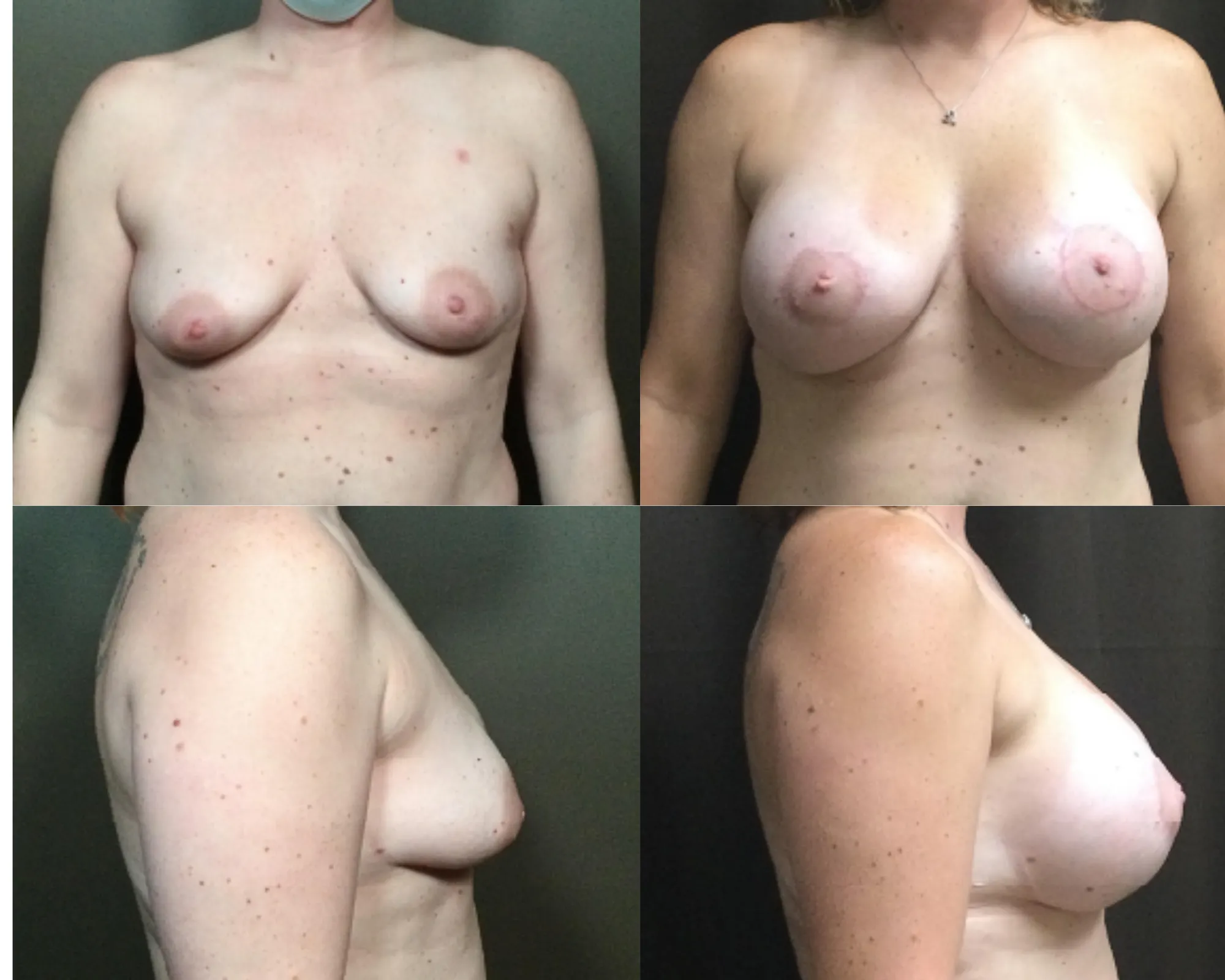 Augmentation And Lift Before and After_7