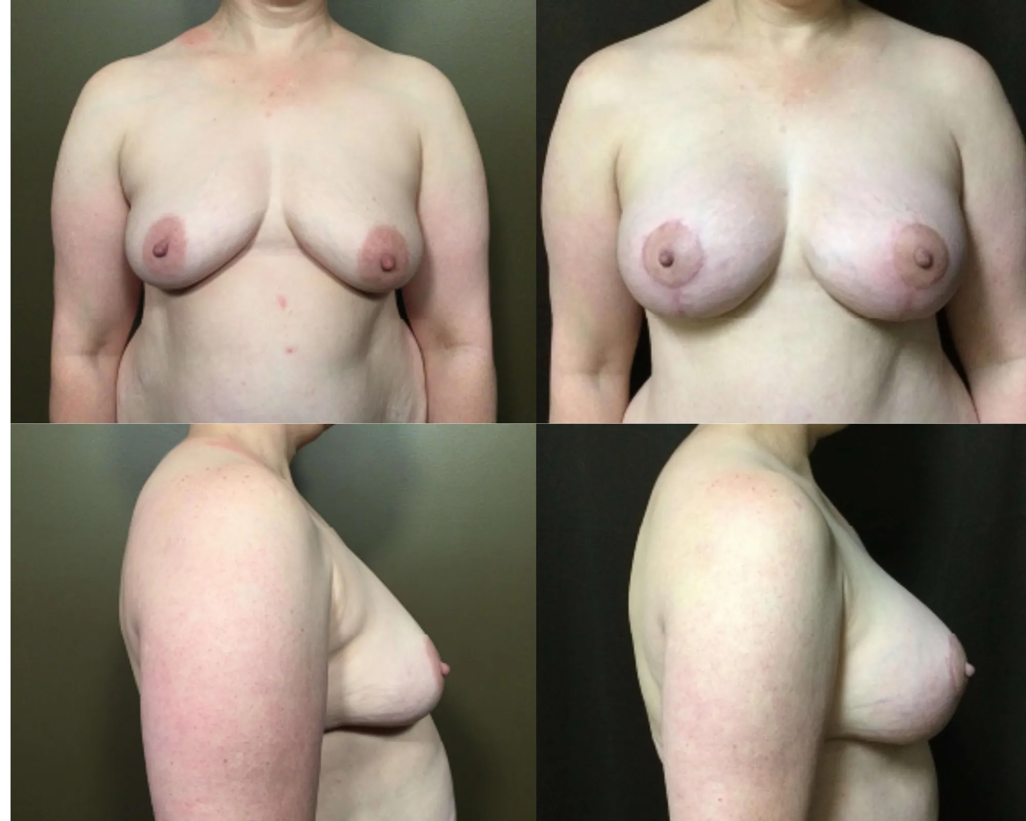 Augmentation And Lift Before and After_8