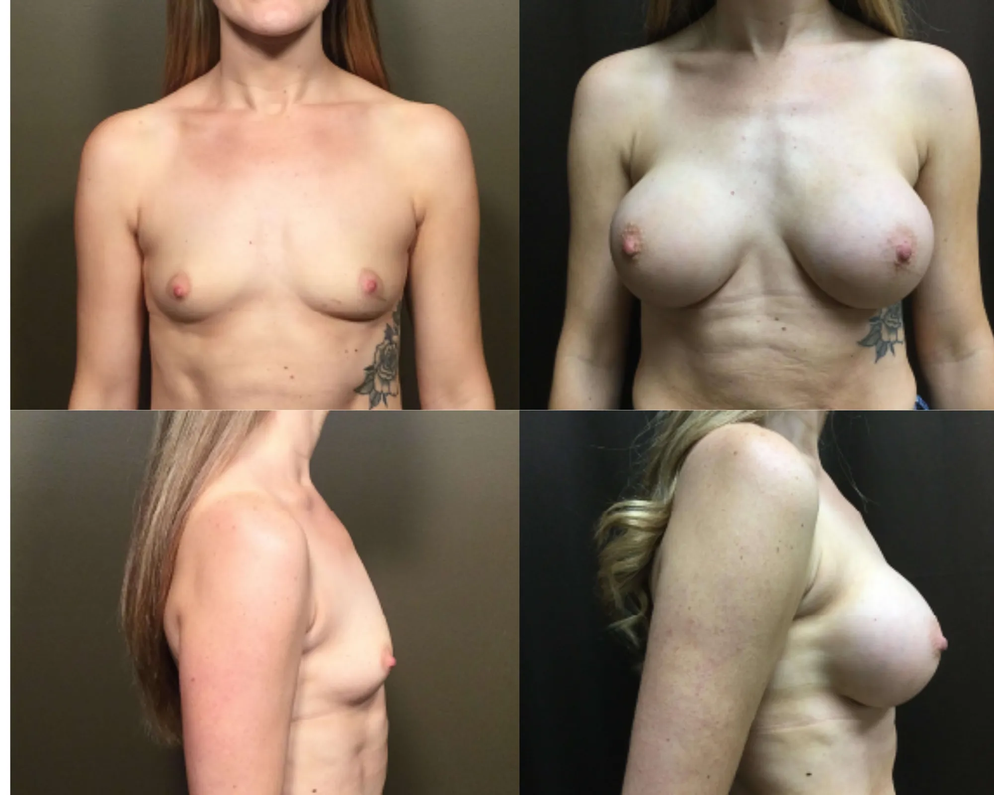 Breast Augmentation Before and After_2