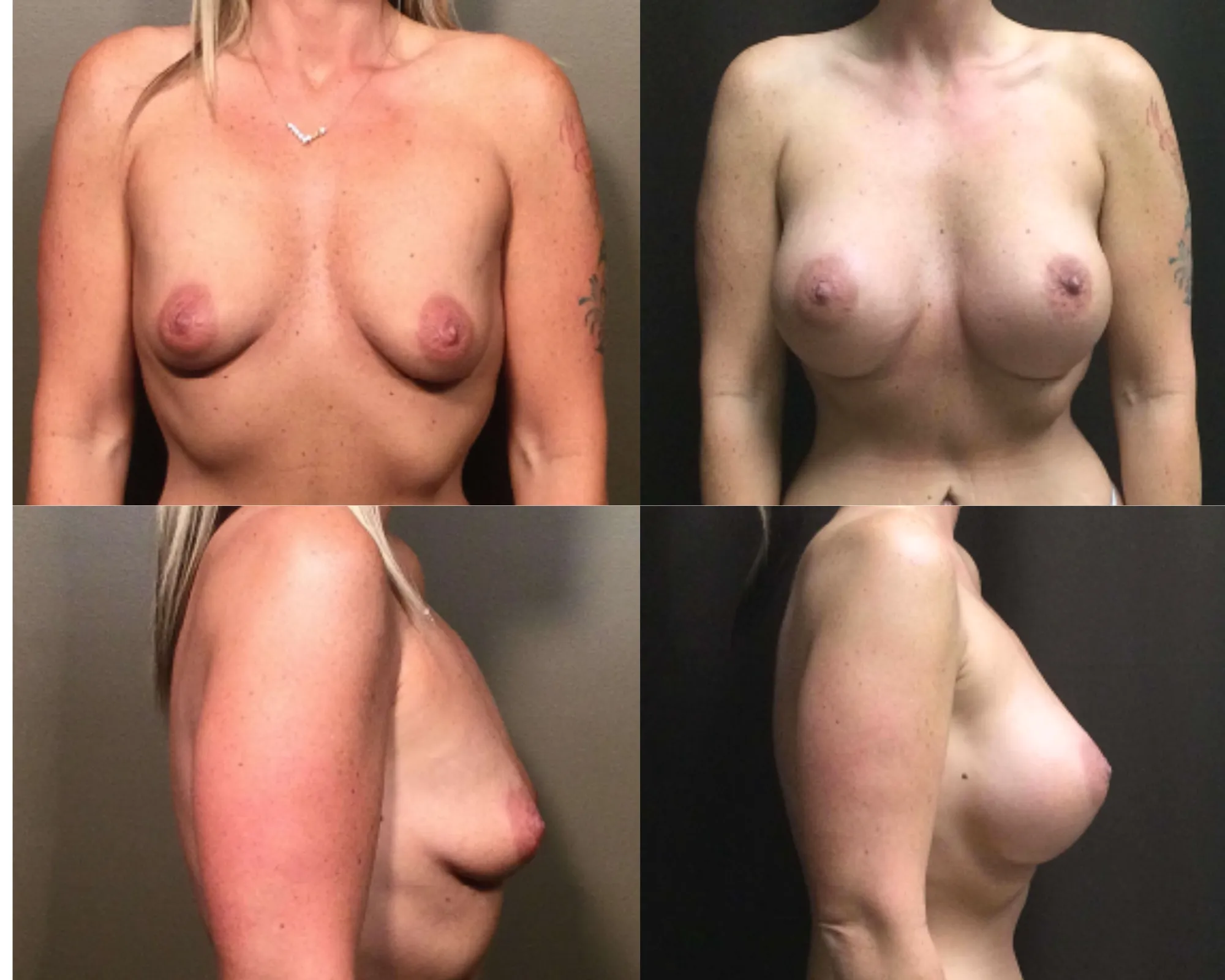 Breast Augmentation Before and After_3