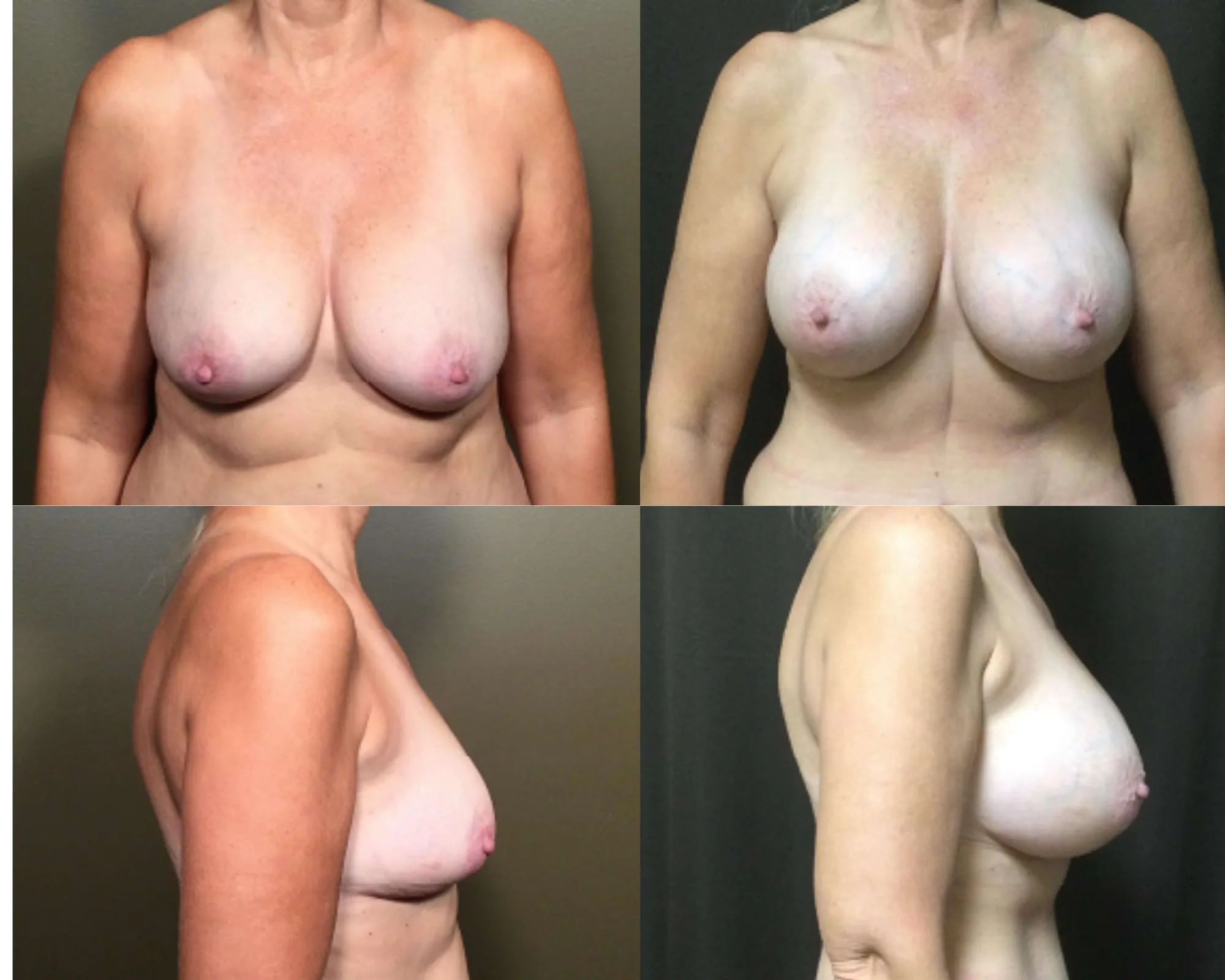 Breast Augmentation Before and After_4