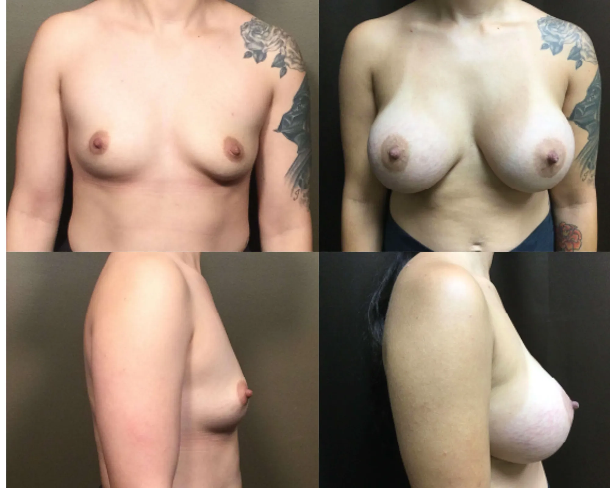Breast Augmentation Before and After_5