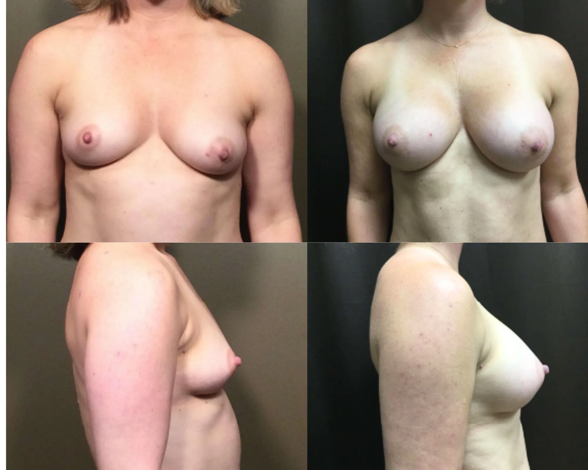Breast Augmentation Before and After_6