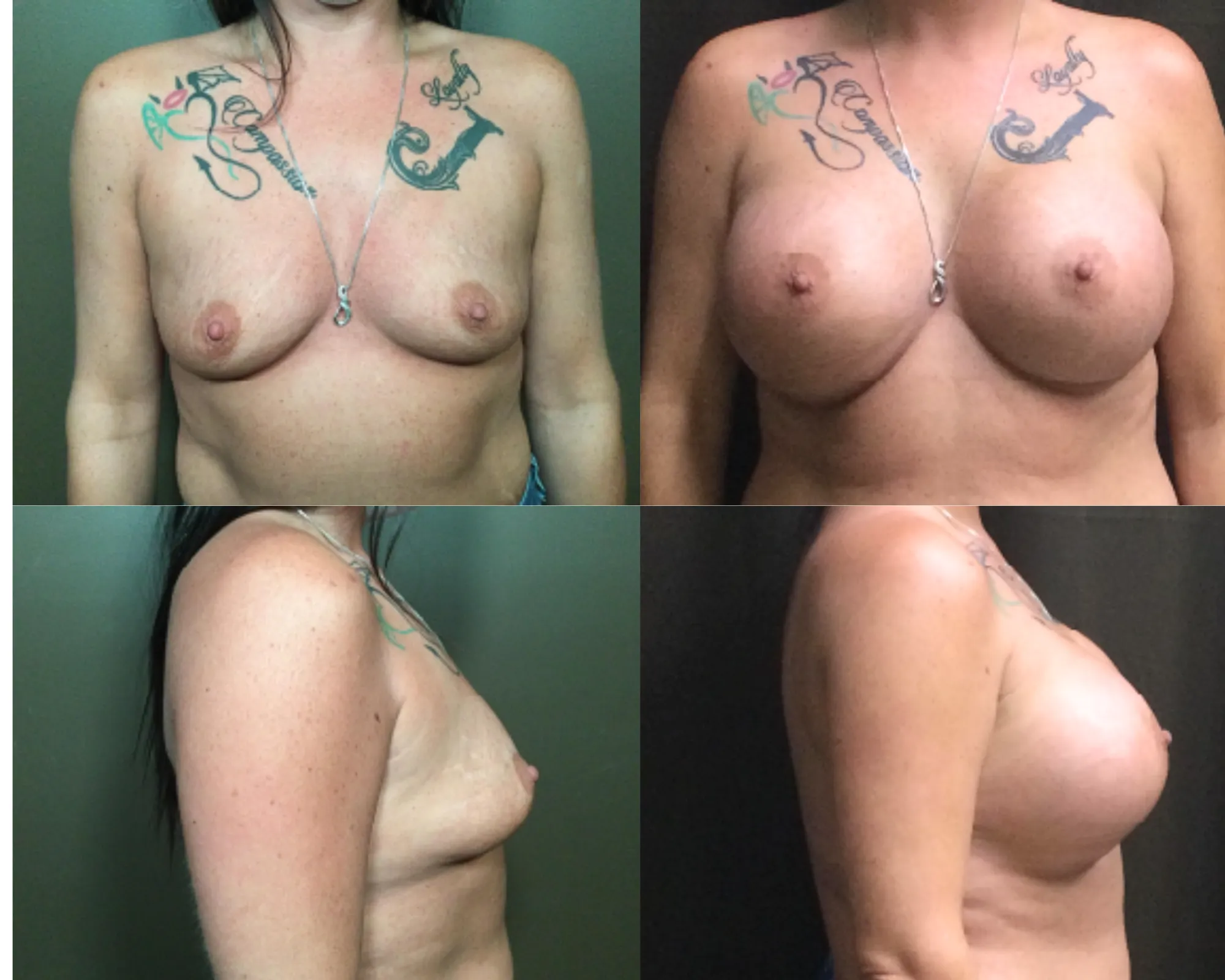 Breast Augmentation Before and After_9