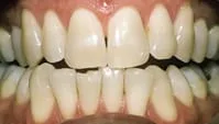 Bleaching - The Dental Practice of Lincoln Park - Chicago, IL