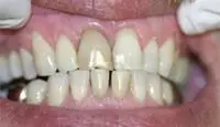 whitening