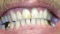 whitening