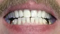 whitening
