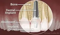 diagram of parts and assembly of dental implants North York, ON implant dentistry