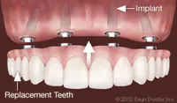 Dental Implants Replace All Teeth.