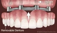 Dental Implants Support Removable Dentures.