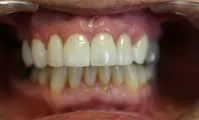 Veneers - The Dental Practice of Lincoln Park - Chicago, IL
