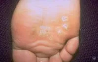 warts-symptoms-foot.jpg