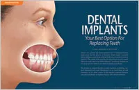 Dental Implants - Dear Doctor Magazine