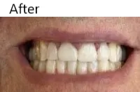 Image of patient after dental work