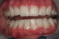 Teeth Whitening in Portage, MI