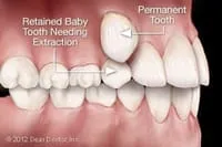 illustration showing mouth with baby tooth blocking permanent tooth, needs tooth extractions North York, ON