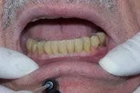 Freehold Dental Implant Procedure
