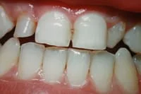 teeth_pics_010.JPG