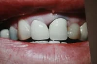 teeth_pics_010.JPG