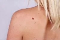 Skin Tags and Mole Removal Treatment at the Fountain Clinic in Rocky River