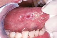 dentist North York, ON examining mouth and tongue for signs of oral cancer