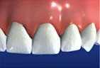 illustration showing bridge in place in mouth and missing tooth restored, dental bridge Gardnerville, NV dentist