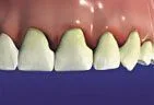 illustration of teeth with swollen bleeding gums, gum disease Gardnerville, NV