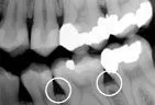 X-ray image showing signs of Periodontitis with teeth, gum disease Gardnerville, NV dentist