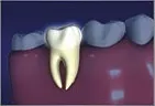tooth with healthy roots, root canal Gardnerville, NV dentist
