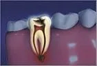 tooth with decay and damage, root canal treatment Gardnerville, NV dentist