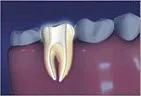 tooth showing root canals, Gardnerville, NV