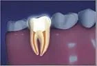 tooth interior after root canal, no infection, filling in tooth. dentist Gardnerville, NV