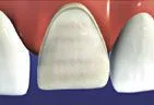 tooth surface is prepared for veneers Gardnerville, NV dentist