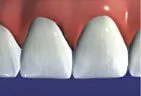tooth after veneer placement complete, Gardnerville, NV dentist