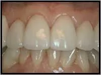 Crown Lengthening_F Neal Pylant Athens GA_Periodontics_Dental Implants