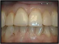 Crown Lengthening_F Neal Pylant Athens GA_Periodontics_Dental Implants