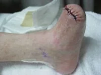 Diabetic amputation of the toes