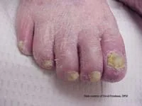 fungal toenails