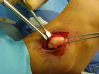 soft tissue tumor in the foot