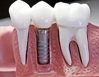 plastic model of gums with a few teeth and an embedded dental implant, implant dentistry Shelby, NC