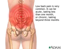 low_back_pain