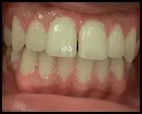 Gingivoplasty/Gingivectomy_F Neal Pylant Athens GA_Periodontics_Dental Implants