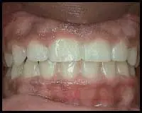 Gingivoplasty/Gingivectomy_F Neal Pylant Athens GA_Periodontics_Dental Implants